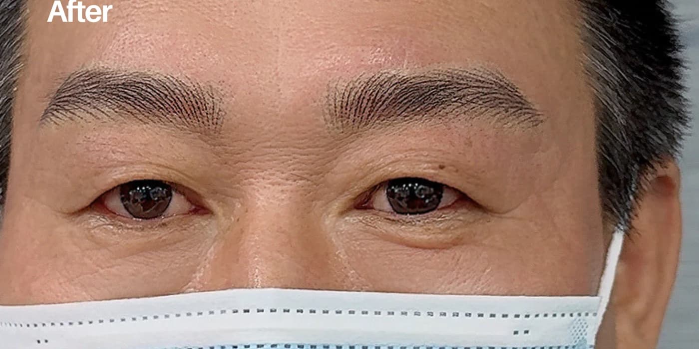 남성 헤어스트록 시술 후