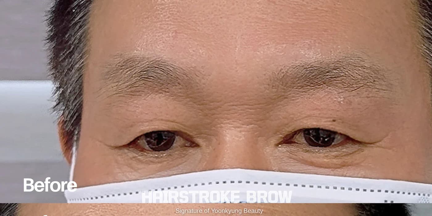 남성 헤어스트록 시술 전